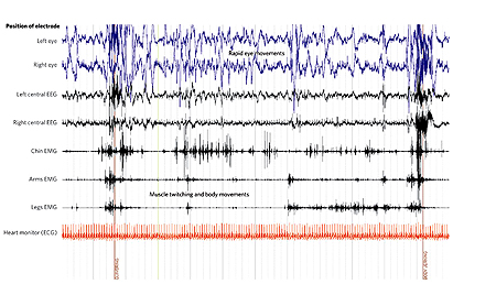 REM EEG2
